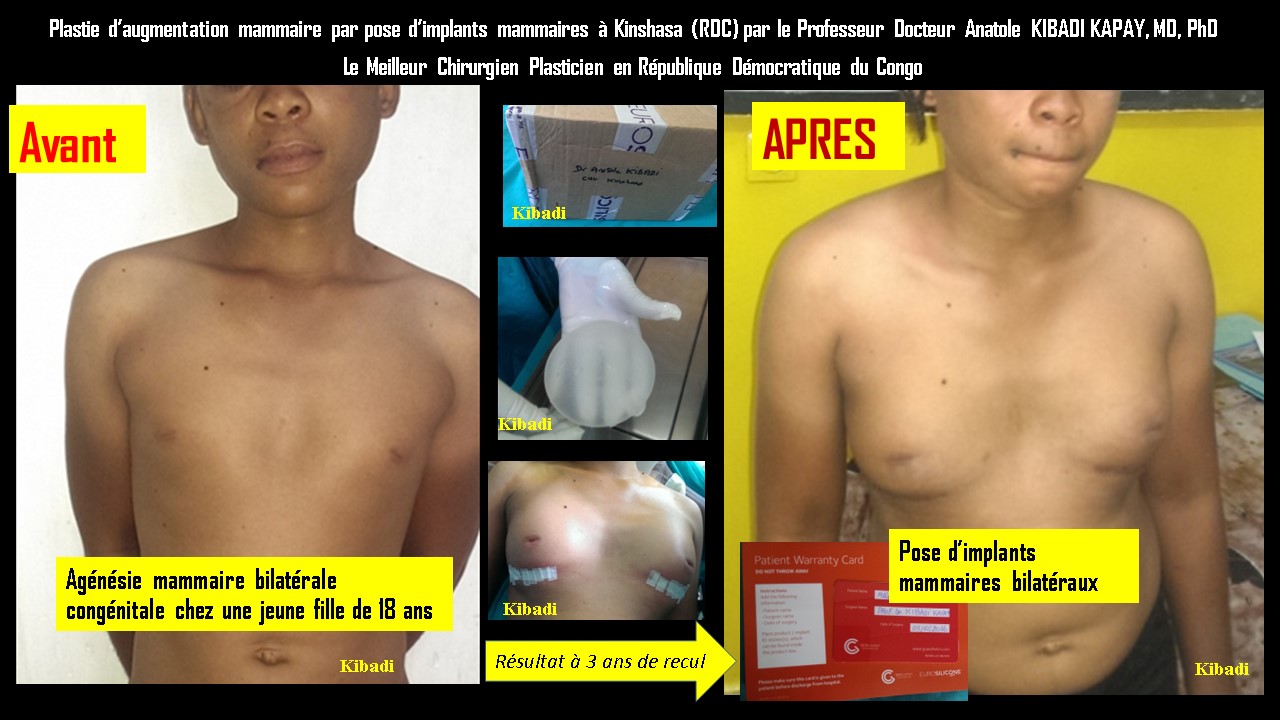 Augmentation de seins par pose des implants mammaires à Kinshasa en RDC par le Professeur KIBADI KAPAY Anatole (MD, PhD), le Meilleur Chirurgien Plasticien de la République Démocratique du Congo
